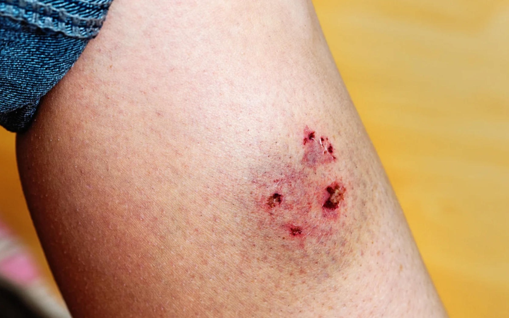 Pogryzienie 13-latka w Oświęcimiu. Wątpliwości wokół szczepień