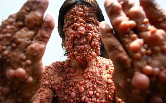 Co to jest choroba Recklinghausena?