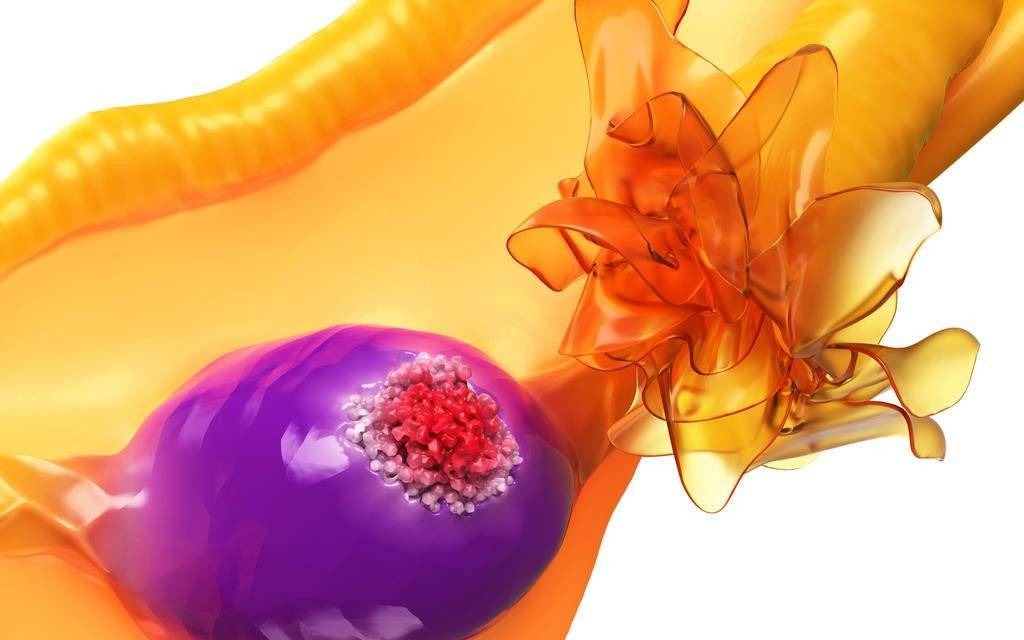 Nowe perspektywy leczenia raka jajnika