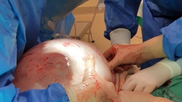 Ginekolodzy z oświęcimskiego szpitala usunęli 25-latce gigantycznego guza