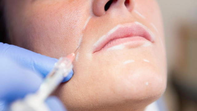 Usta, kwas hialuronowy – jak uniknąć efektów ubocznych?